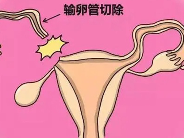 宫外孕可能会切除输卵管