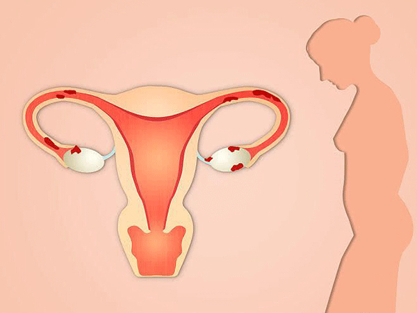 阴道出血可能是子宫内膜病变