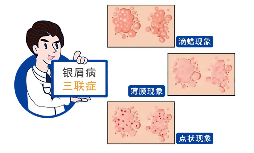 准确诊断银屑病的几种方法 南京皮肤科医院
