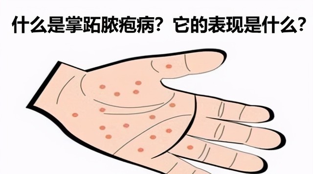 手掌脓疱病或掌跖脓疱病怎么引起的，传染吗，如何治疗 南京银屑病医生在线咨询