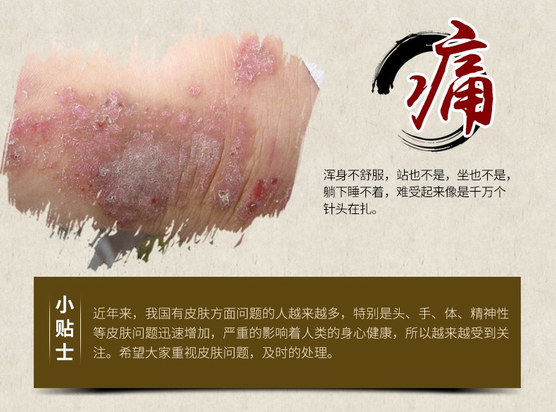 南京治疗银屑病口碑好的医院 牛皮肤癣有什么治疗方法