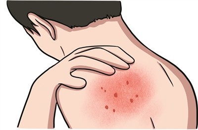 上海治皮肤病该去哪家医院-过敏性皮炎会带来哪些影响