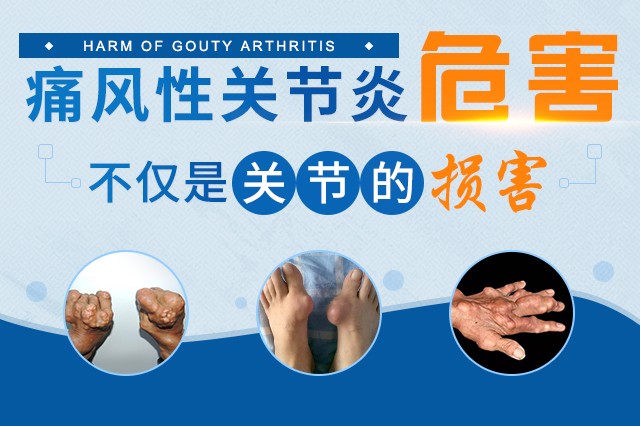 痛风早期的10个征兆你知道哪些 南京治疗痛风去哪个医院?